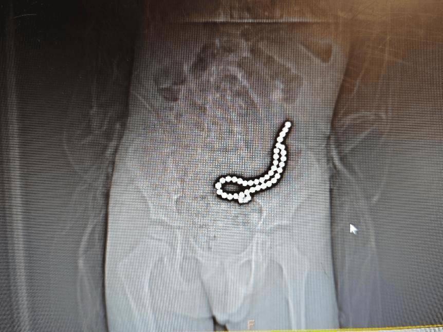 拜仁慕尼黑足球
_整整37颗拜仁慕尼黑足球
!云南4岁孩子身体里取出……医生紧急提醒!