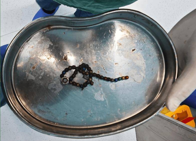 拜仁慕尼黑足球
_整整37颗拜仁慕尼黑足球
!云南4岁孩子身体里取出……医生紧急提醒!