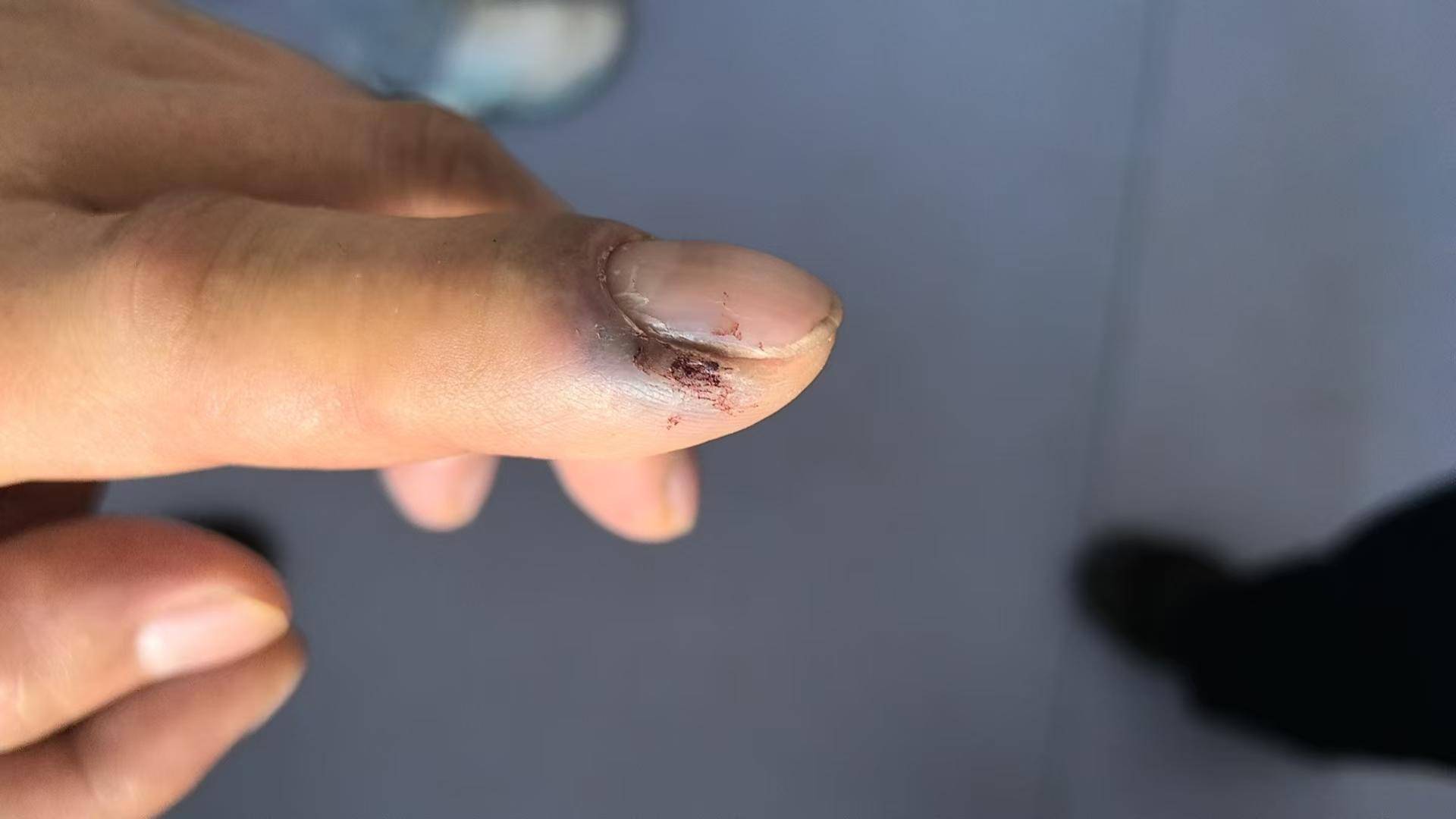 皇冠登一登二登三区别_青海一男子被罕见剧毒阿拉善蝮蛇咬伤皇冠登一登二登三区别,因无血清一度想放弃治疗 警车开道转运700公里救命