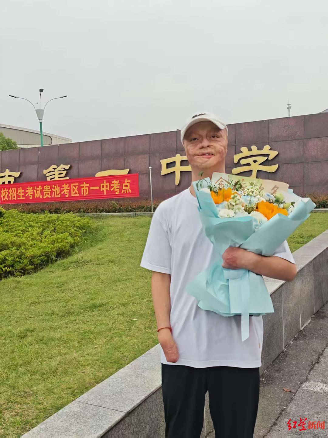 皇冠球網怎么做代理_“烧伤男孩”高考664分被东南大学录取:曾经历23次手术皇冠球網怎么做代理,计划未来读研读博