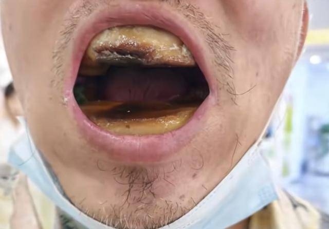 皇冠信用网出租代理_网购5元树脂补牙口腔如长出“烤年糕”皇冠信用网出租代理,老人求医无果引同情