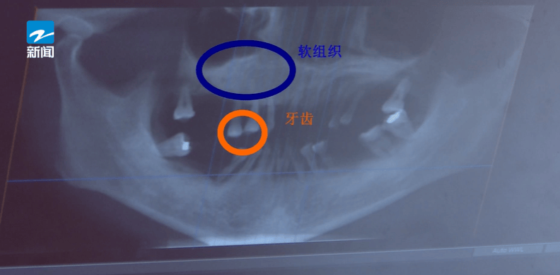 皇冠体育App下载_44岁女子牙齿掉光皇冠体育App下载!只因这个很多人都忽视的“小问题”……
