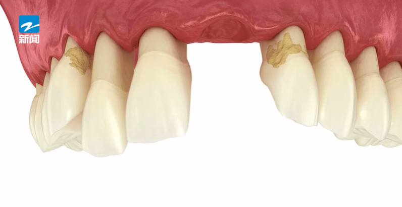 皇冠体育App下载_44岁女子牙齿掉光皇冠体育App下载!只因这个很多人都忽视的“小问题”……