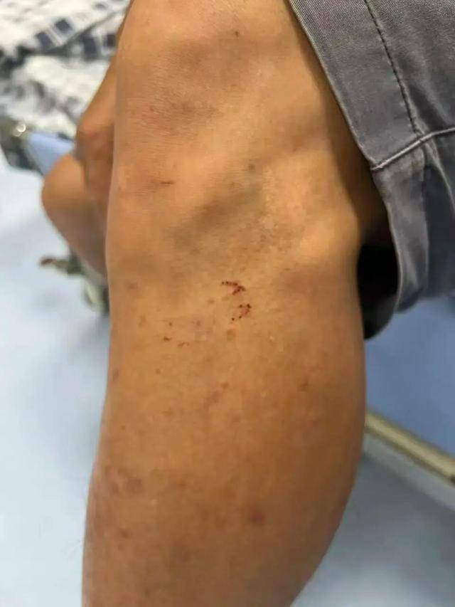 皇冠信用網需要押金吗
_广东62岁阿叔网鱼网到2条眼镜蛇皇冠信用網需要押金吗
,被咬伤后当场打死,并打包提进医院